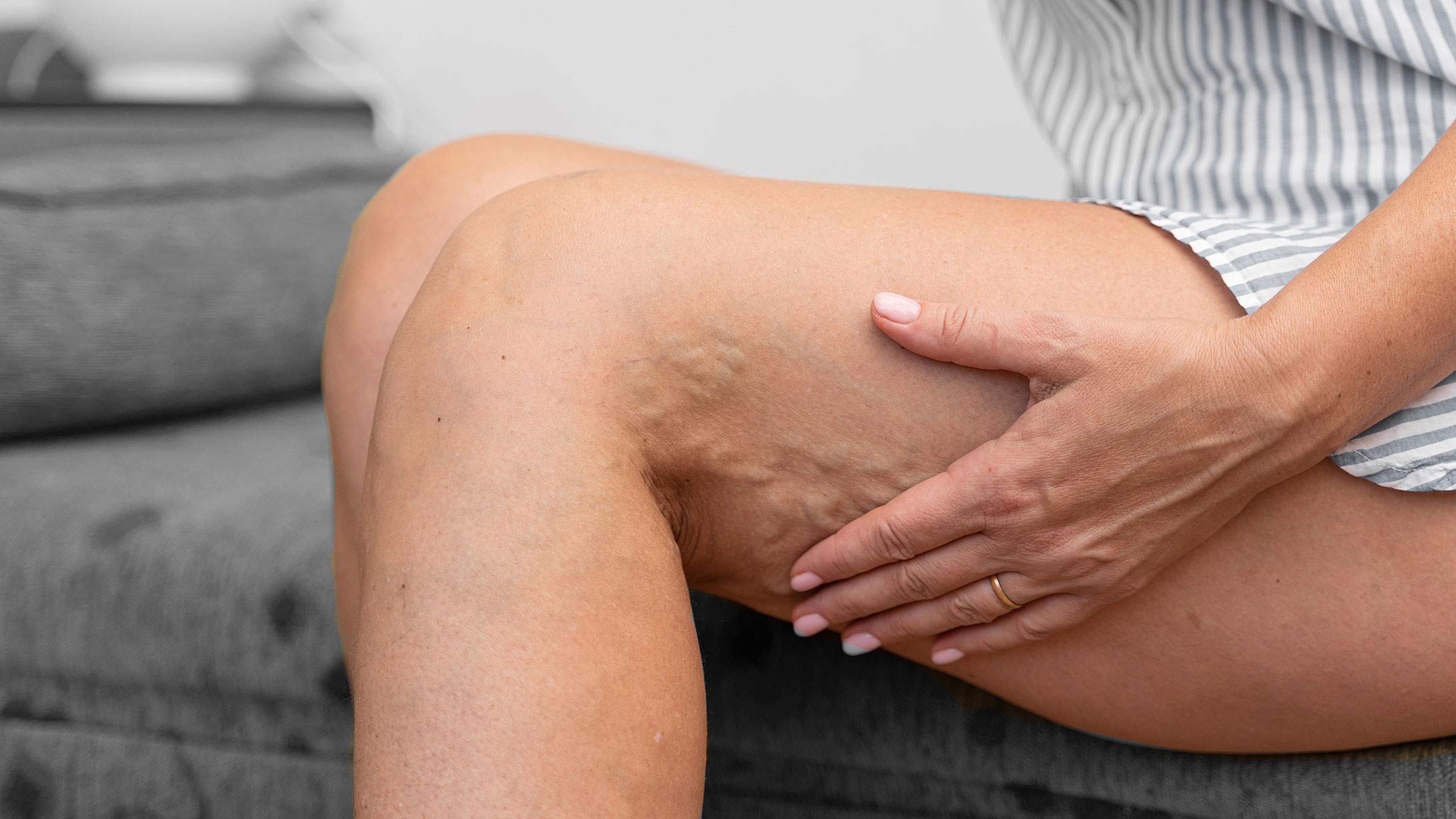 Das Bild zeigt die Beine einer sitzenden Frau. In ihren Kniekehlen sind Krampfadern ersichtlich.