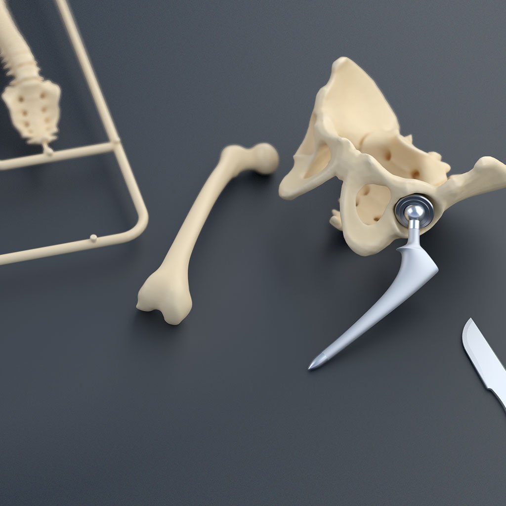 Orthopädie: Modell eines künstlichen Hüftgelenks