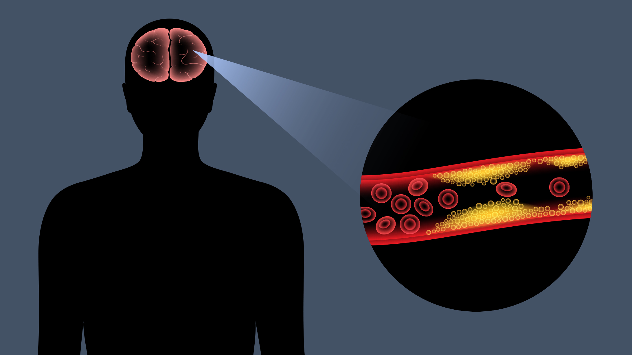 Die Illustration zeigt die Vergrösserung einer Arterie im menschlichen Gehirn. Das Blut kann nicht ungehindert fliessen, da sich an der Arterienwand Kalk und Blutfette abgesetzt haben.