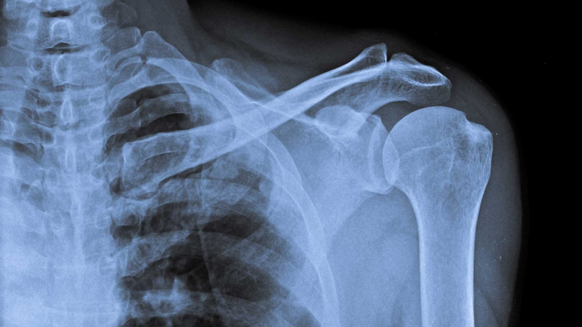 Röntgenbild eines Schultergelenks