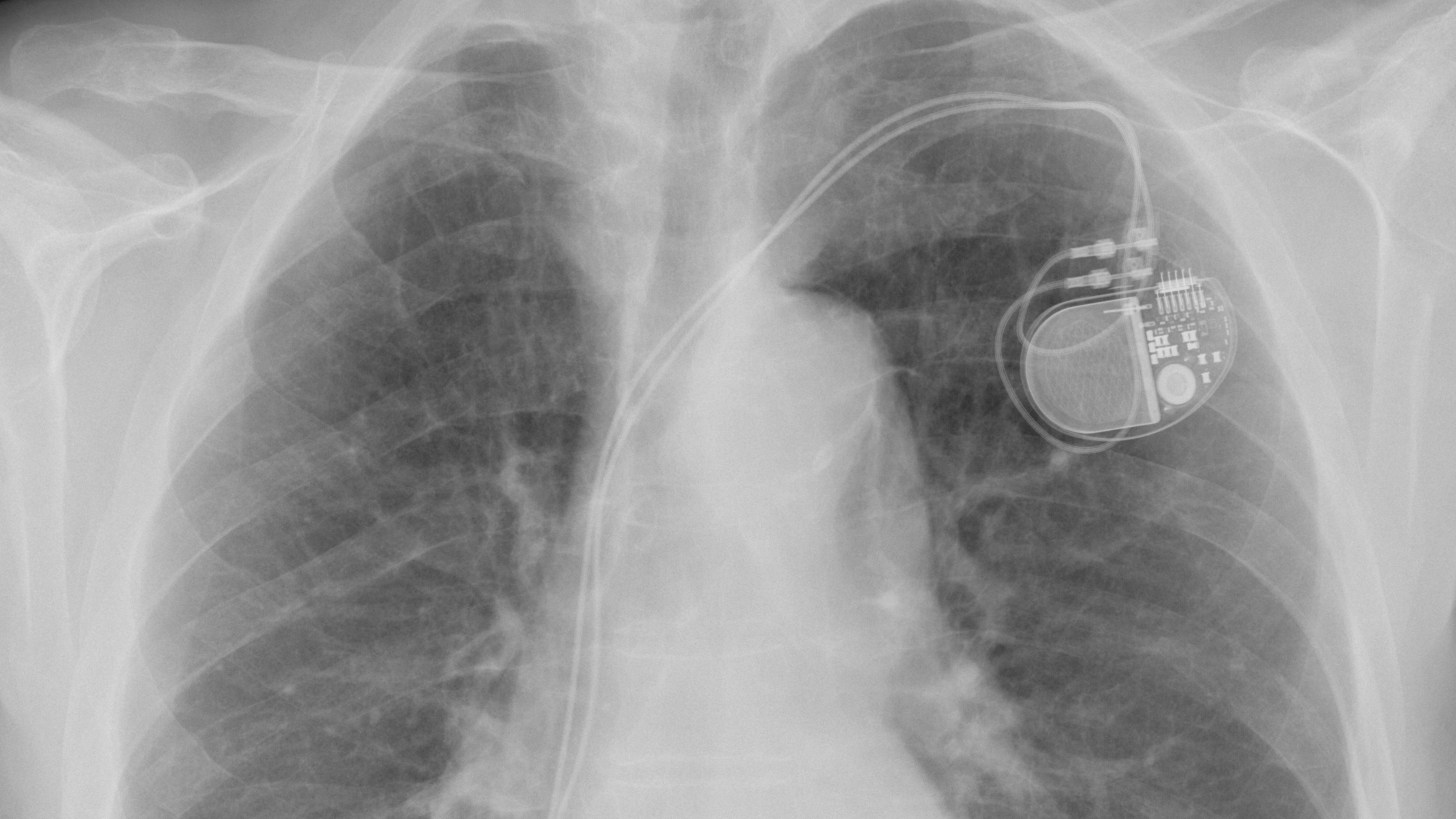 Herzschrittmacher-Operation: Ein Röntgenbild des Brustkorbs mit einem implantierten Herzschrittmacher