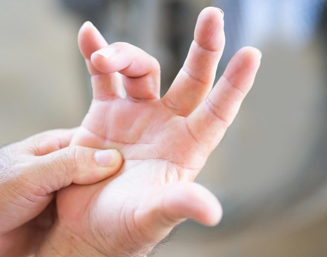 Schnappfinger: eine Hand mit einem gebeugten Ringfinger.