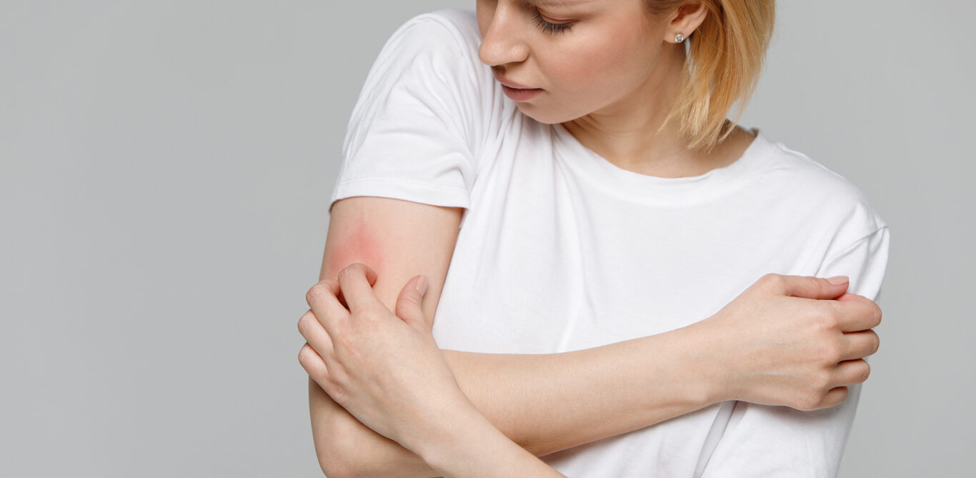 Eine Frau kratzt sich an einer geröteten Stelle am Arm.