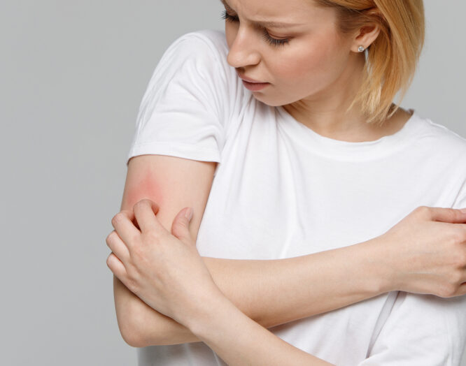 Eine Frau kratzt sich an einer geröteten Stelle am Arm.