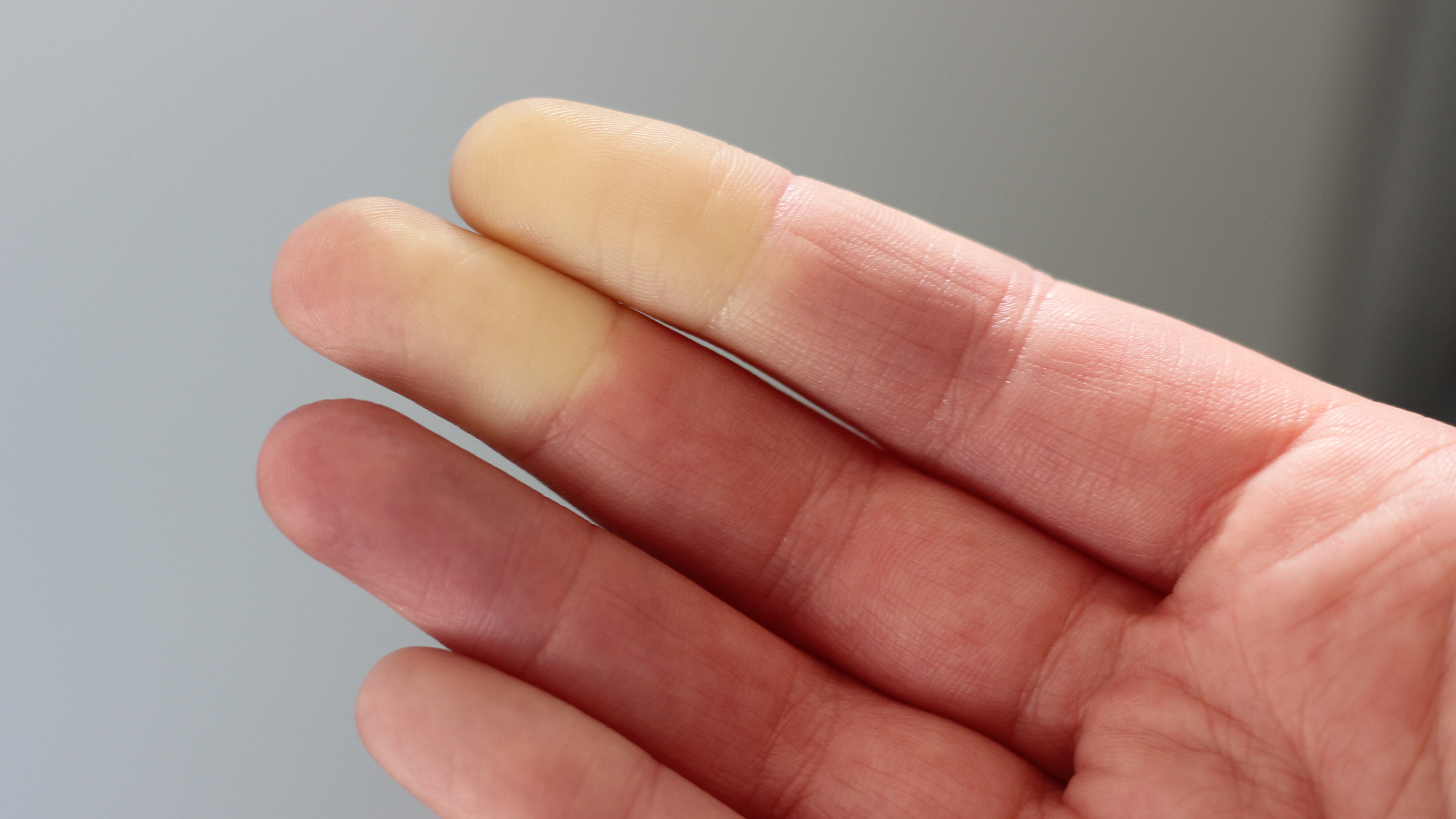 Kalte Hände: Frauenhand mit Raynaud-Syndrom