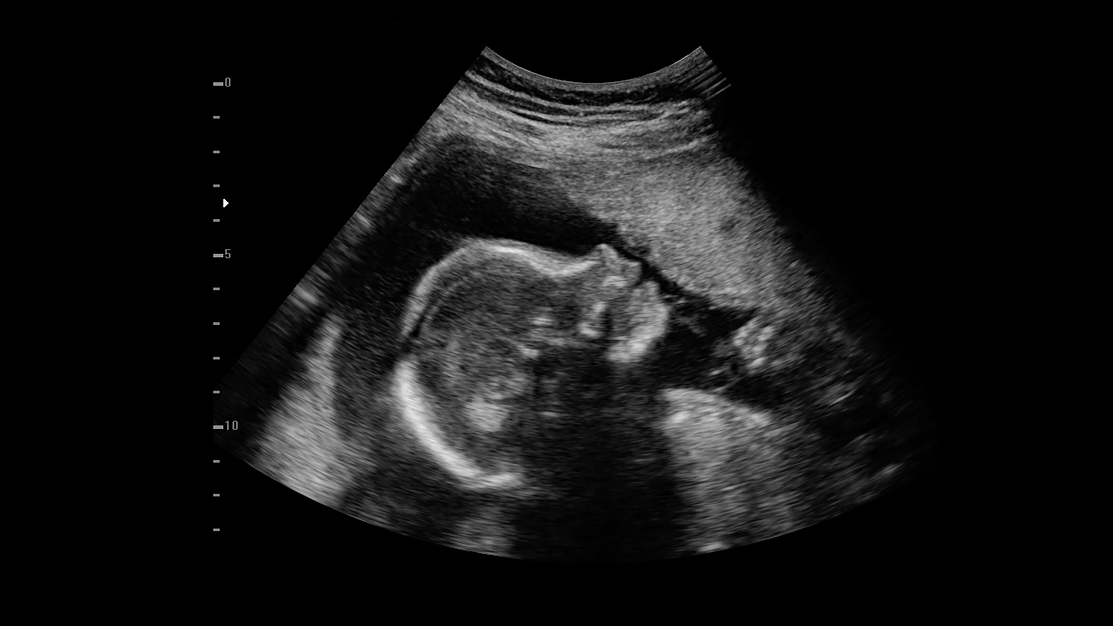 Ultraschallbild eines Babys.