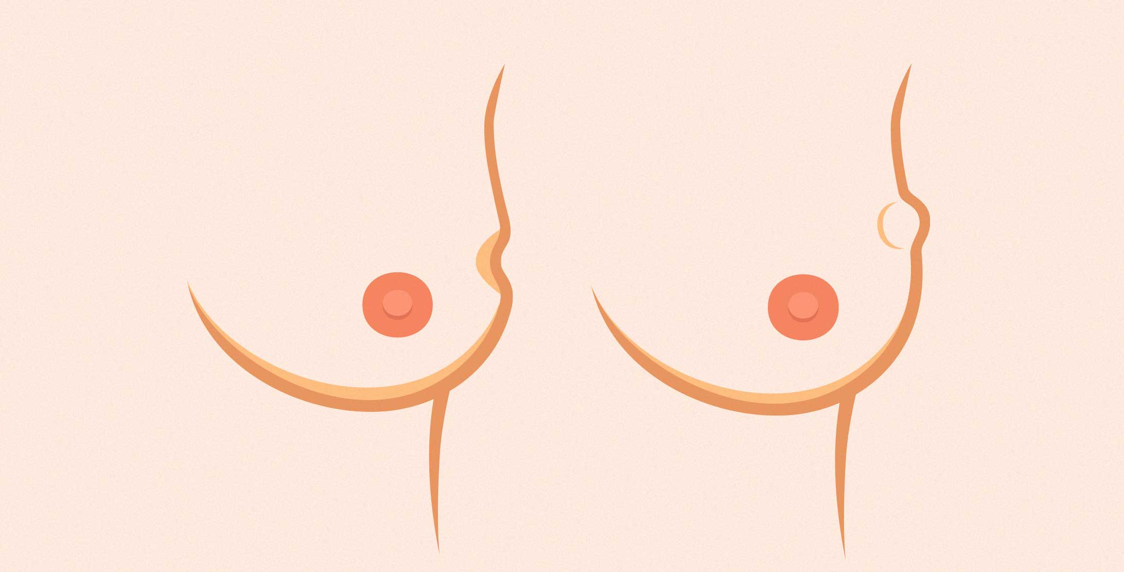 Illustration einer weiblichen Brust mit Dellen oder Vorwölbungen