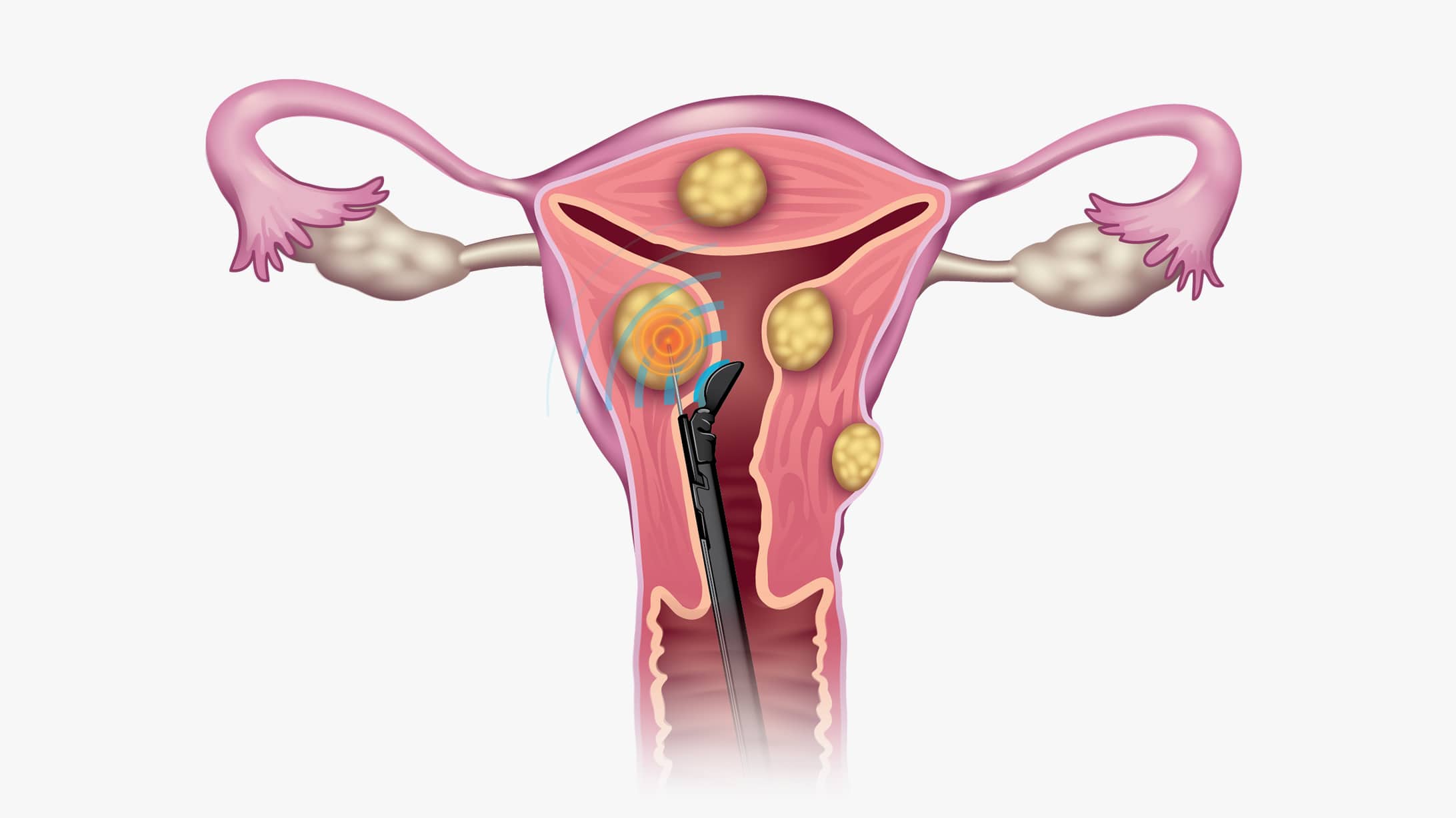 Querschnitt der weiblichen Reproduktionsorgane . Dies zeigt die Grafik