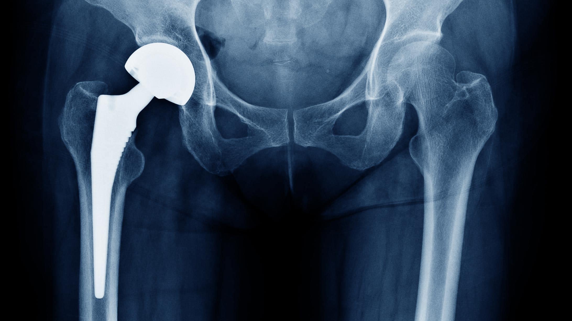 Röntgenbild einer Hüfte mit einem künstlichen Hüftgelenk
