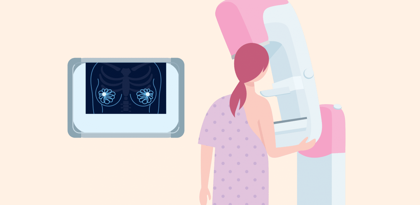 Illustration einer Mammographie