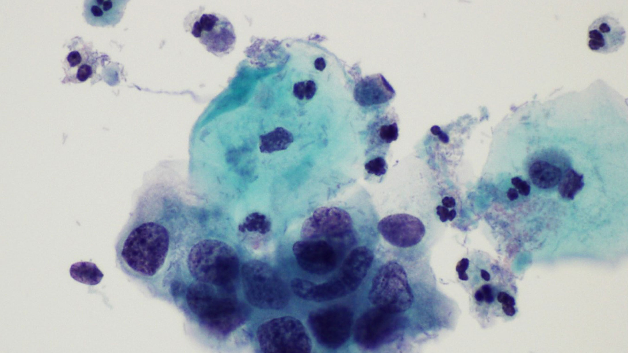 Gebärmutterhalskrebs: veränderte Zellen unter dem Mikroskop