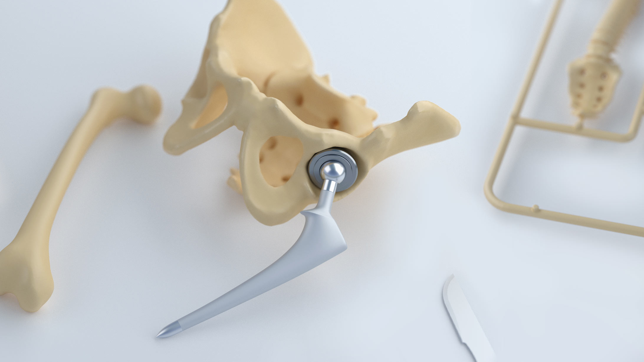 Implantate – Antworten auf die wichtigsten Fragen – KSB-Blog