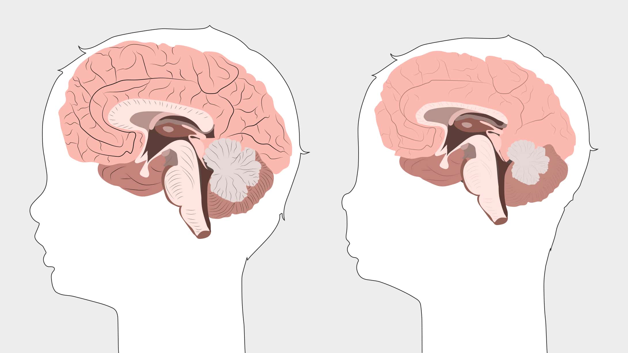 Alkohol und Schwangerschaft: Eine Illustration mit zwei seitlichen Querschnitten eines Neugeborenengehirns. Links ein normalentwickeltes Gehirn, rechts eines mit Schäden durch Alkoholkonsum der Mutter.