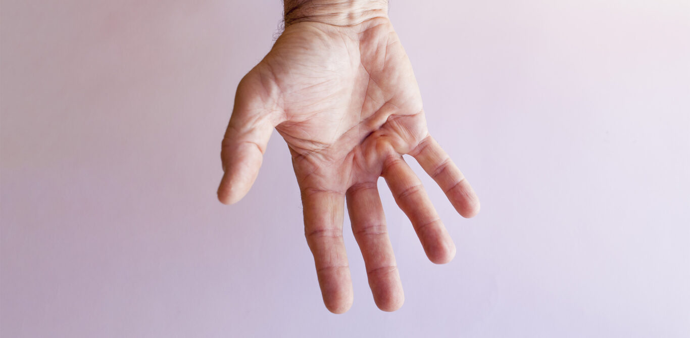 Bild einer männlichen Hand als Symbolbild eines Morbus Dupuytren.
