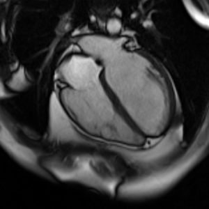 Eine MRI-Aufnahme des Herzens.