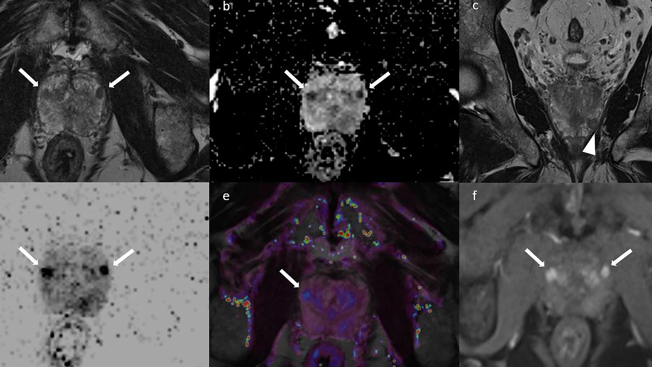 Sechs verschiedene MRI Aufnahmen der Prostata