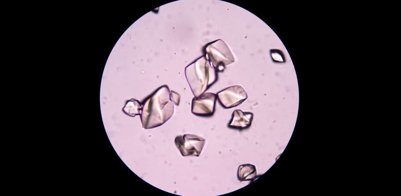 Gicht: Kristalle unter dem Mikroskop