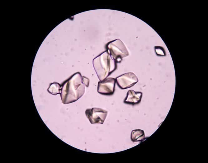 Gicht: Kristalle unter dem Mikroskop